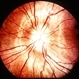 Papilledema